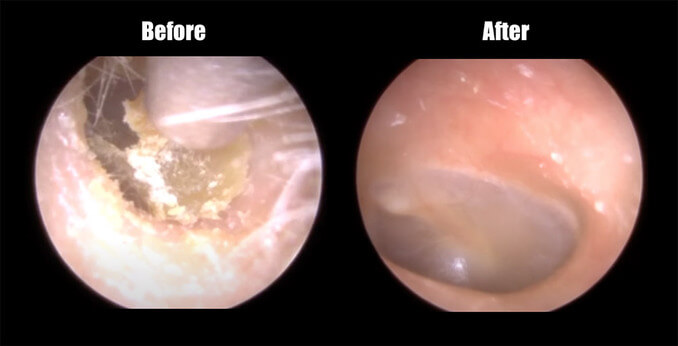 Before and After an Earwax Removal Procedure